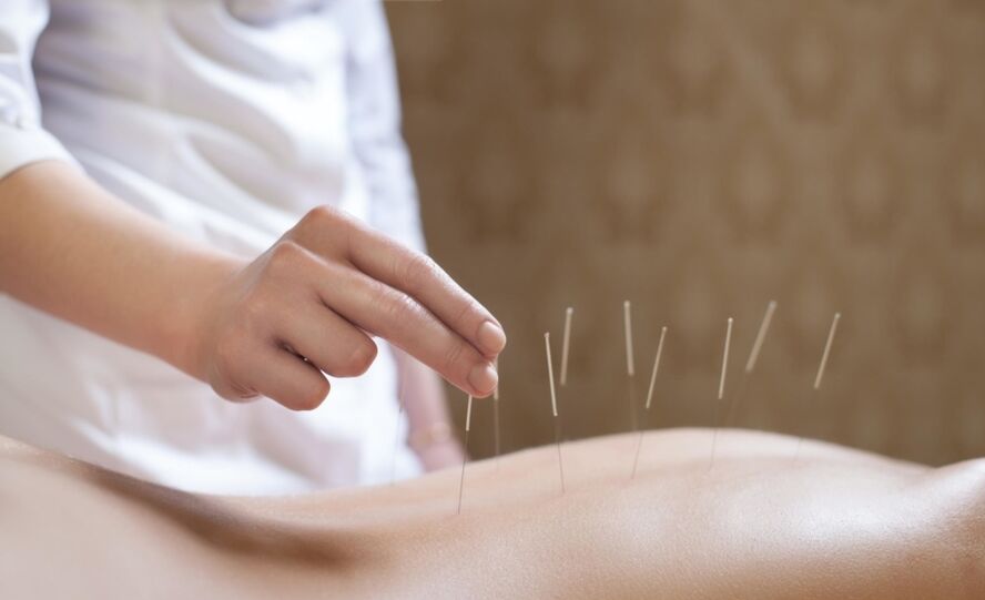 acupunctură